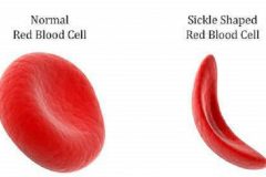 Cameroonian children with sickle-cell disease face death