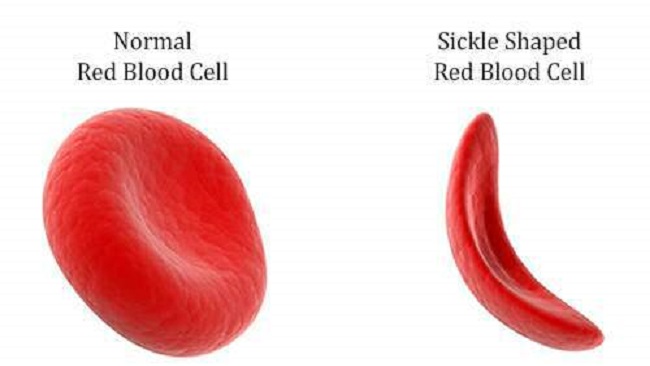 Cameroonian children with sickle-cell disease face death