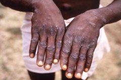 Monkeypox outbreak spreads to five regions in Cameroon