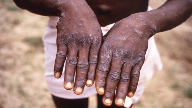 Monkeypox outbreak spreads to five regions in Cameroon