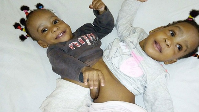 Once conjoined, Cameroonian sisters spend first Christmas as regular twins in Lyon