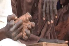Cameroon sees resurgence of leprosy 20 years after ‘eradication’