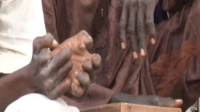 Cameroon sees resurgence of leprosy 20 years after ‘eradication’