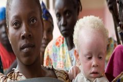 albinism Cameroon Albinos Ask for Greater Attention, Care