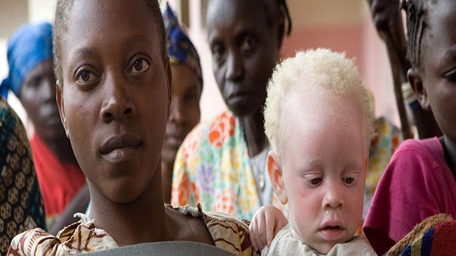 Cameroon Albinos Ask for Greater Attention, Care