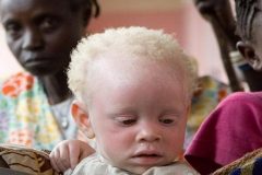 Albinos in Cameroon Cameroon’s albinos threatened by magic and superstition
