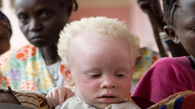 Albinos in Cameroon Cameroon’s albinos threatened by magic and superstition