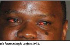 Cameroon’s ongoing battle with Conjunctivitis