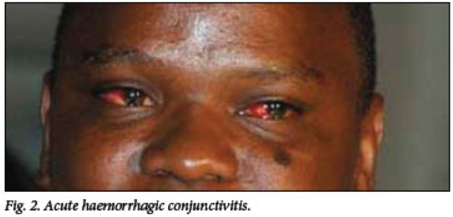 Cameroon’s ongoing battle with Conjunctivitis